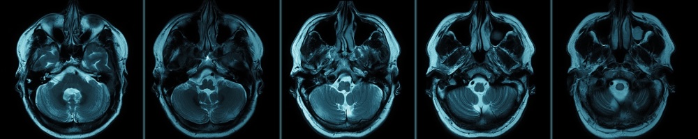 Five images from a head CT scan in a row, showcasing different cross-sectional views. Each scan displays detailed internal brain structures in shades of blue and black.